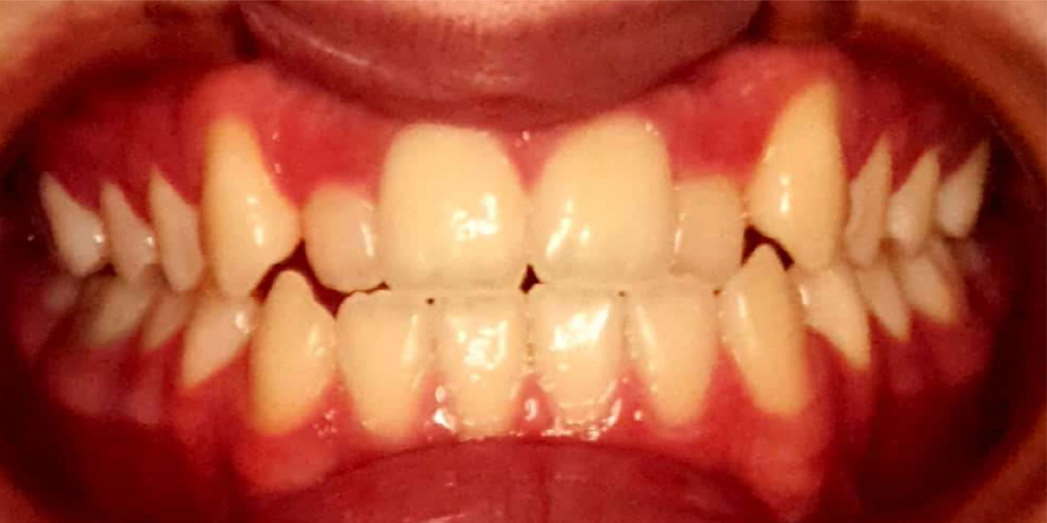 aparelhos invisíveis Invisalign antes e depois