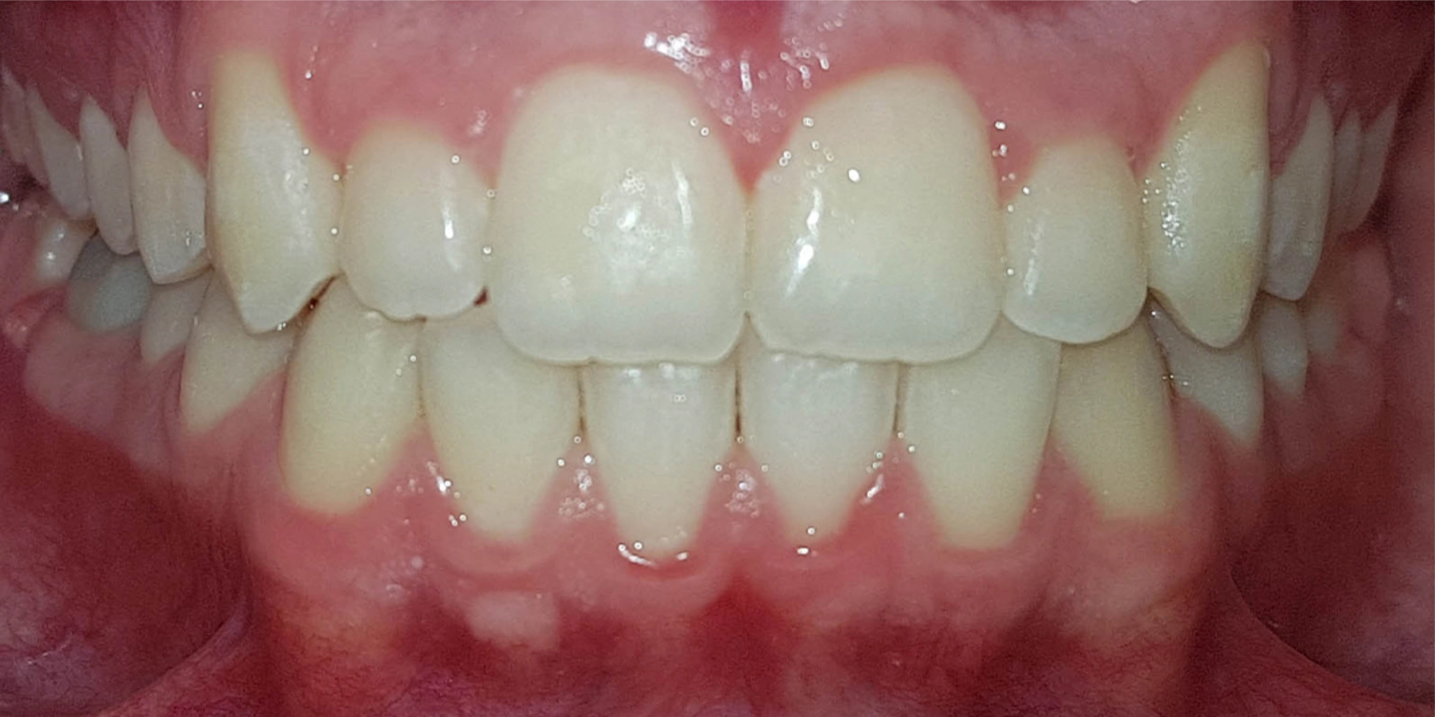 aparelhos invisíveis Invisalign antes e depois
