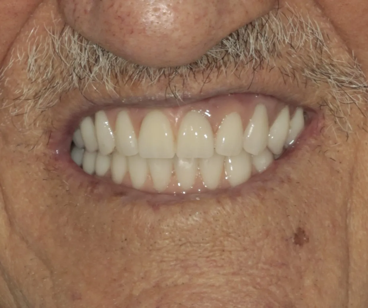 protese_protocolo_depois